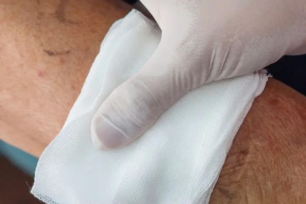 A gloved hand holds a white gauze pad on a person's arm. A gloved hand holds a white gauze pad on a person's arm.