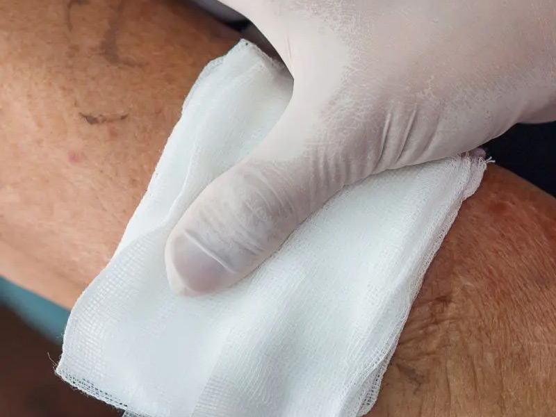 A gloved hand holds a white gauze pad on a person's arm.